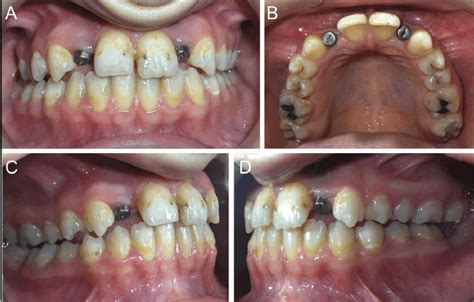Intraoral View Of The Patient After Replacement Of Gingiva Former