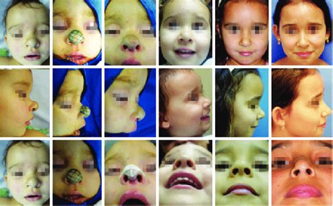 Deep Infantile Hemangioma In The Proliferative Phase Affecting The Tip