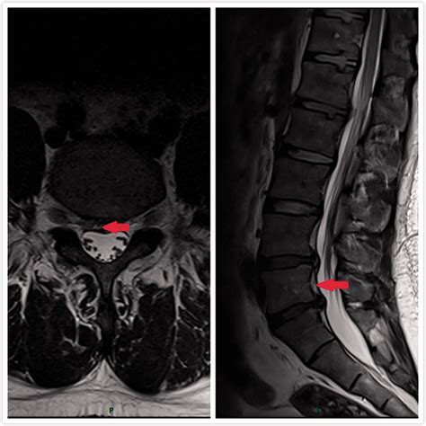 Spontaneous Regression Of A Large Sequestered Lumbar Disc Herniation A
