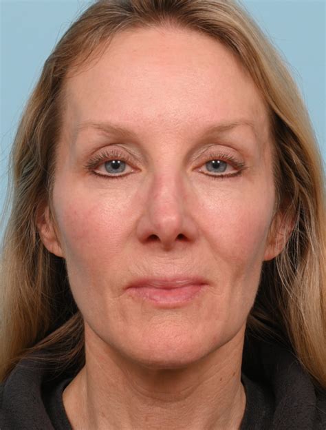 Del Mar Facial Fat Transfer Before And After Photos San Diego Plastic