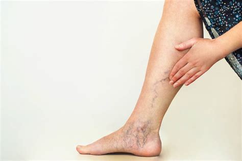 When Does Vein Treatment Qualify For Insurance Coverage Denver Vein