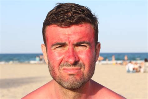Funny Sunburn Stock Photos Pictures And Royalty Free Images Istock