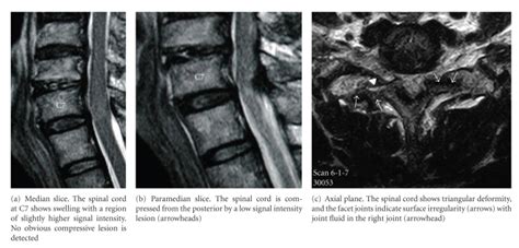 Severe Facet Joint Arthrosis Caused C7t1 Myelopathy A Case Report