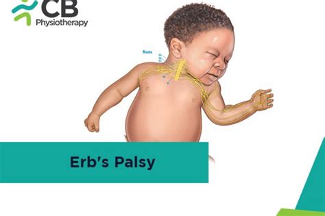What Is Erbs Palsy Symptoms Causes Diagnosis And Physiotherapy