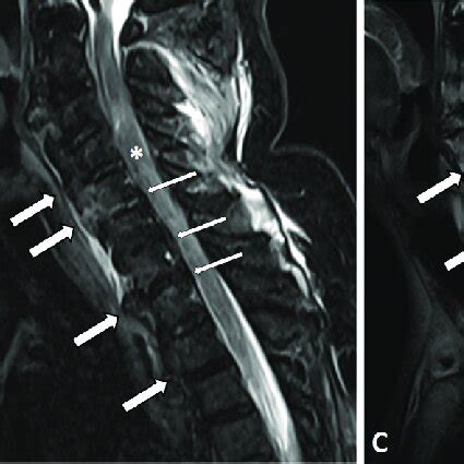 Sagittal Cervical Spine CT And T Weighted T W MRI Images Of A Download Scientific Diagram