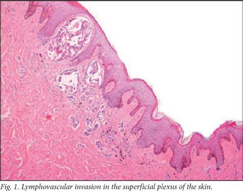 Figure 1 From The Histology Of Peau Dorange In Breast Cancer What