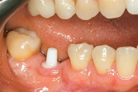 Lower Molar 2 Zirconia Dental Implants