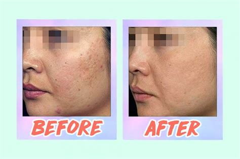 5 Acne Scar Laser Treatments In Singapore From S88 That Work—including