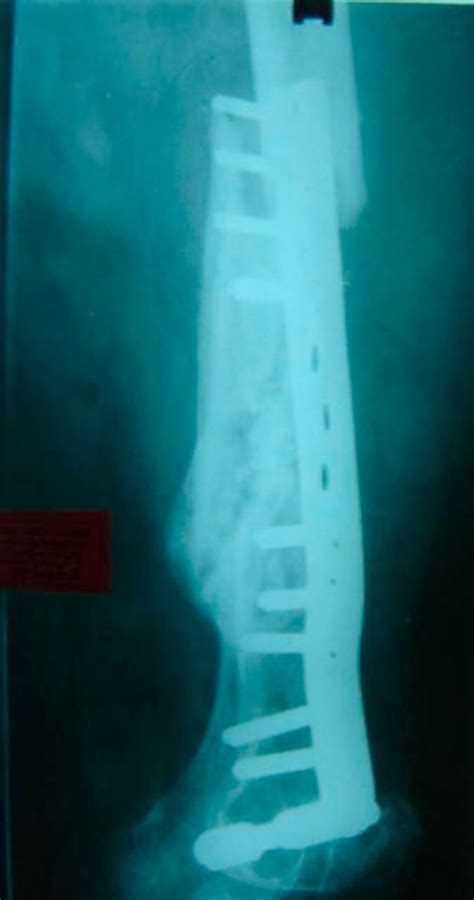 X Ray Showing Peri Implant Fracture The Previous Peri Implant Fracture