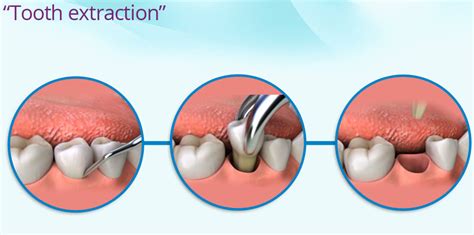 Tooth Extraction Single Root