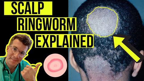Doctor Explains Scalp Ringworm Tinea Capitis Including Causes
