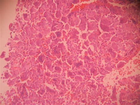 Giant Cell Tumor Of Bone Histopathologyguru