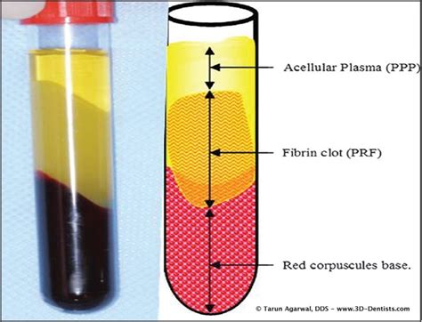 Figure 1 Preparation Of Platelet Rich Fibrin 3 Layers Platelet Rich