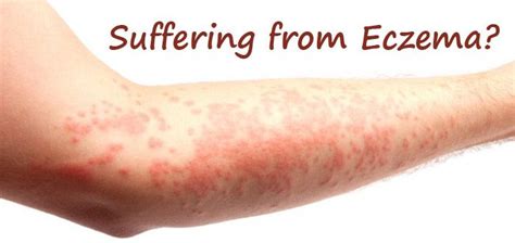 Eczema And Its Ayurvedic Treatment 100 Natural Treatment