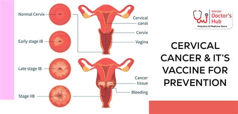 Cervical Cancer M Doctors Hub