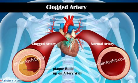 Clogged Arterycausessymptomstreatmentcomplicationsdiagnosis