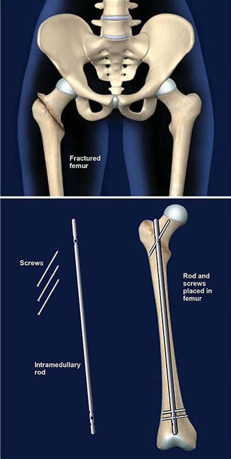 Femur Fracture Fixation With Intramedullary Rod Central Coast