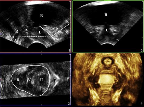Four Dimensional Ultrasound Of A Woman With Pelvic Organ Prolapse