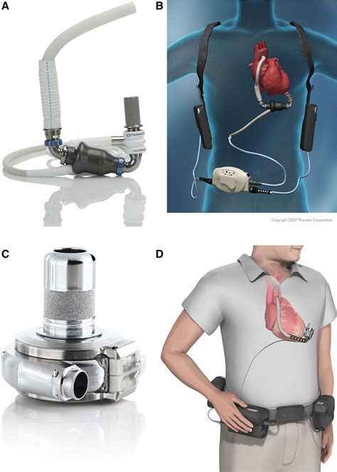 Recommendations For The Use Of Mechanical Circulatory Support