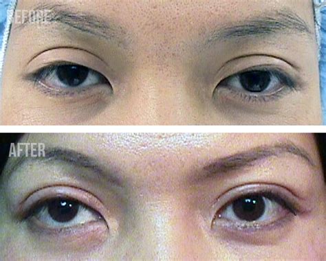 Asian Eyelid Surgery Center Cosmetic And Asian Double Eyelid Surgery