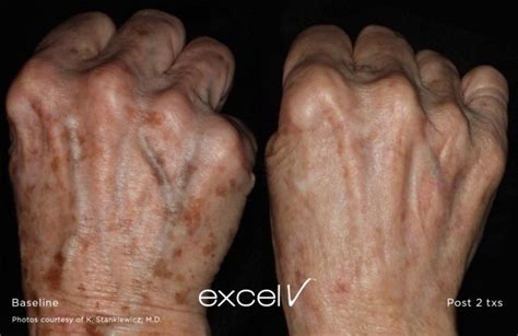 Excel V Hands Skin By Design Dermatology And Laser Center Pa