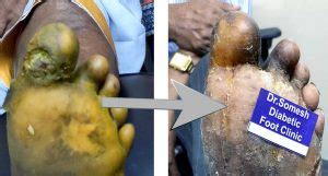 Diabetic Gangrene Stages Great Toe Base Podiatry Doctor