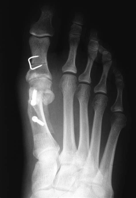 Modern Concepts In The Treatment Of Hallux Valgus Bone And Joint