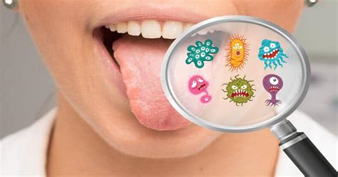 Herpes On Tongue Learn About Risks Causes And Treatment Dentaly Org