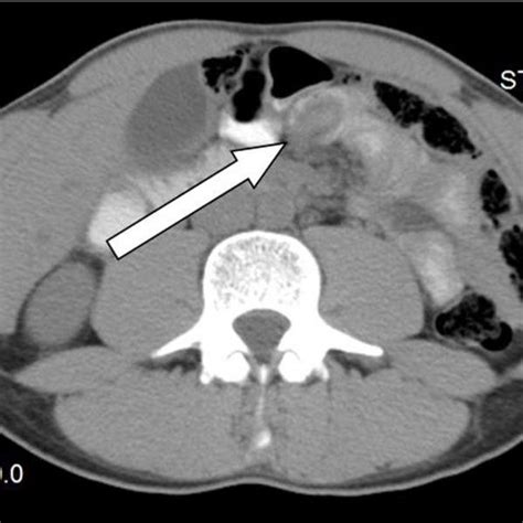 Computed Tomography Ct Scan Of The Abdomen And Pelvis With Iv