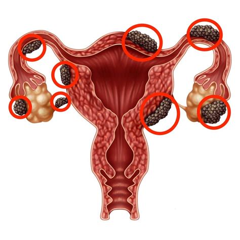 La Endometriosis En Guadalajara Cl Nica Para La Mujer En Guadalajara