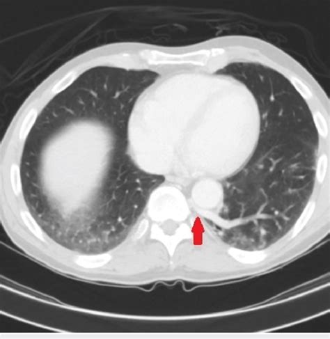 Axial Ct Scan Of The Chest With Contrast Demonstrating Anomalous