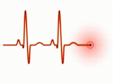 ekg-1024x762.gif