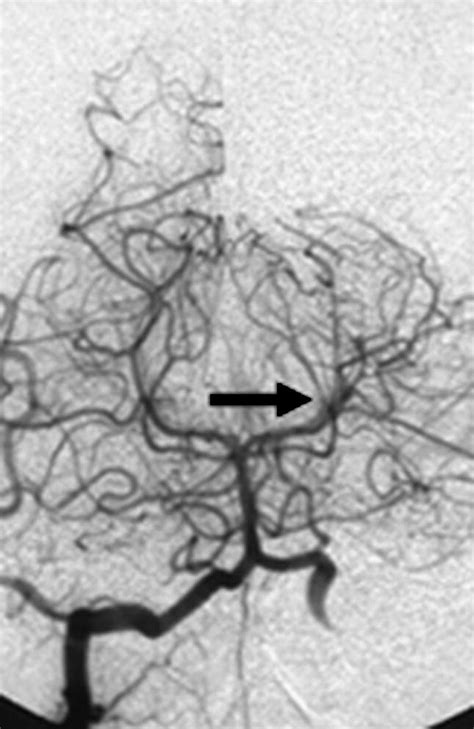 Postpartum Dissecting Aneurysm Of The Posterior Cerebral Artery