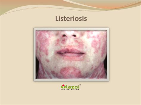 PPT Listeriosis Causes Symptoms Daignosis Prevention And
