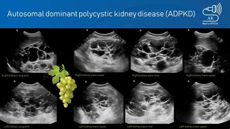 Autosomal Dominant Polycystic Kidney Disease Nephropocus
