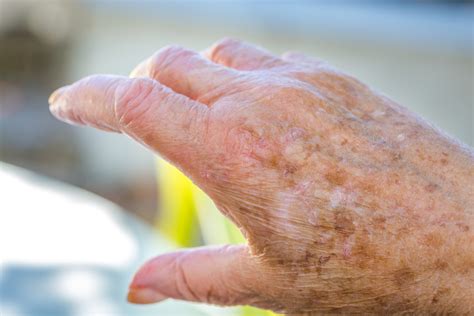 Skin Changes In The Elderly Partners In Care