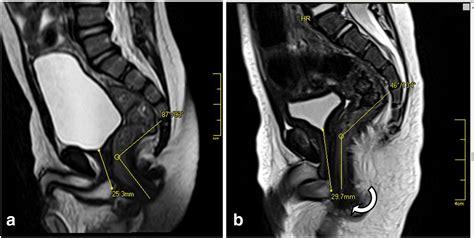 Low Type Anorectal Malformations In The Male Extent Of Deviation From