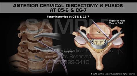 Anterior Cervical Discectomy And Fusion At C5 6 And C6 7 Youtube
