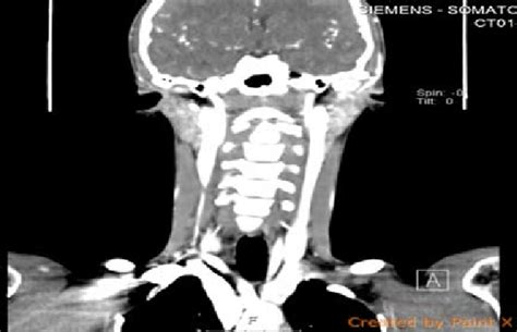 Coronal Ct Scan Of The Neck Showing Enlarged Bilateral Jugulodigastric