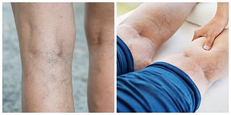 Whats The Difference Between Varicose Veins And Spider Veins Windy