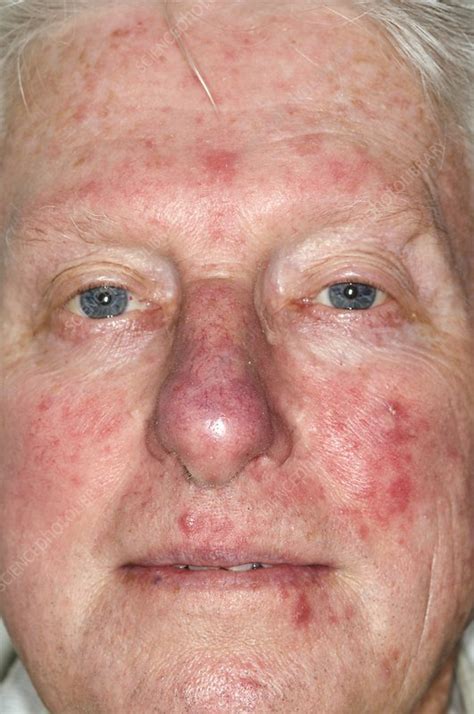 Acne Rosacea On The Face Stock Image C0029590 Science Photo Library