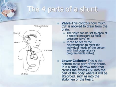 Ppt Hydrocephalus And Shunts Powerpoint Presentation Id431868
