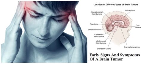 Early Symptoms Of Brain Cancer Canceroz