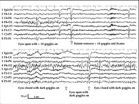 John Libbey Eurotext Epileptic Disorders Fixation Off Sensitivity