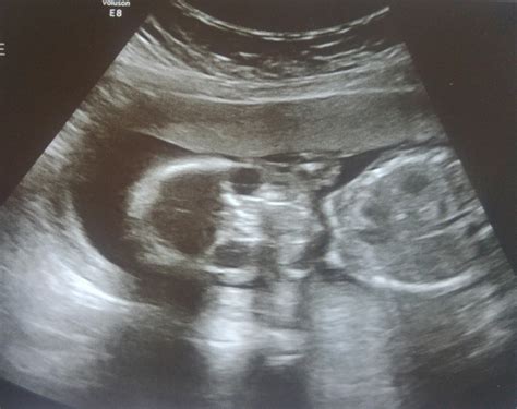 Week 20 Ultrasound Baby Larrabee