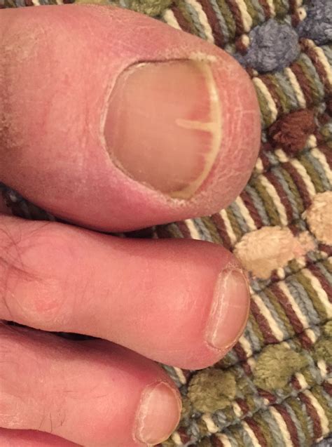 Toenail Fungus Dr William Stych Dpm And Dr Jeff Stych Dpm