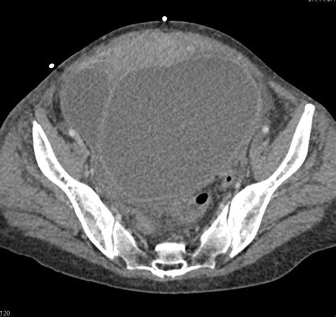 Ovarian Carcinoma Obgyn Case Studies Ctisus Ct Scanning