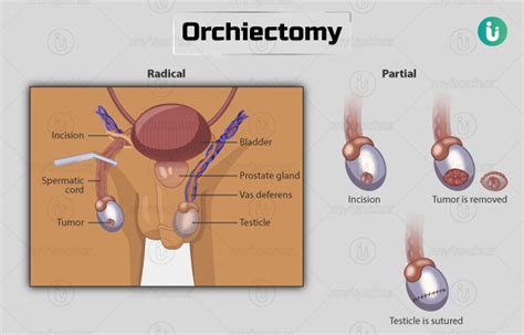 Orchiectomy Procedure Purpose Results Cost Price