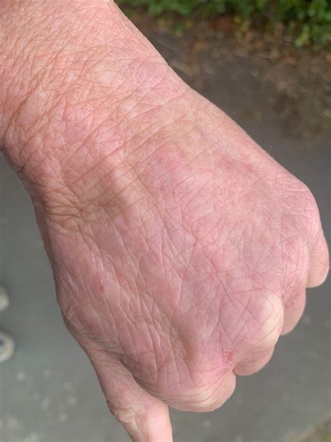 Can Gel Gloves Help Heal Hand Eczema What Allergy Blog
