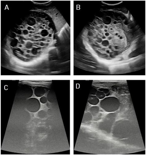 Hydatid Cyst Radiological Pictorial Review Encyclopedia Mdpi